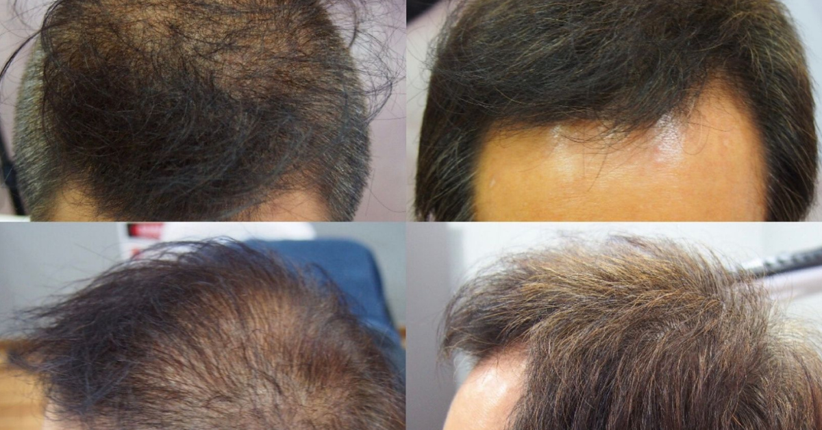 Best Hair Loss Treatments In Malaysia That You Need To Try Today ...